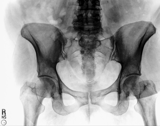 Fig. C7-77 AP pelvis (male or female?).