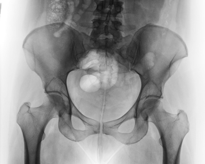 Fig. 7-46 AP pelvis. Ischial Hip bone Femoral spine Coccyx Sacrum (ilium) head R