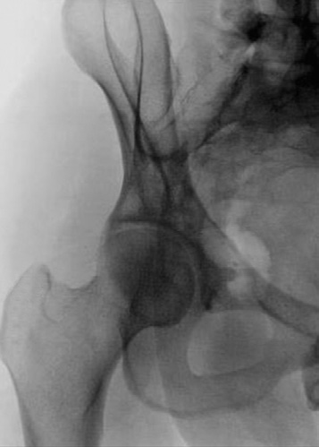 rim of Femoral Anterior partially Obturator head iliopubic by foramen column (open) Fig. 7-61 LPO—upside acetabulum.