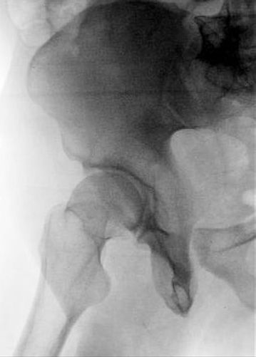 Fig. 7-58 Fig. RPO—downside (anterior rim and posterior rim [ilioischial] column). column). Iliac wing Posterior Iliac (elongated) ilioischial column (foreshortened) R