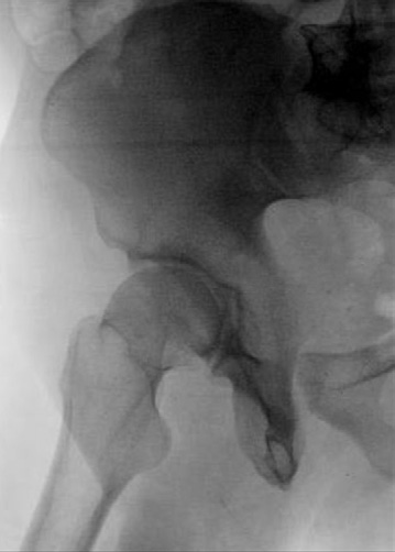 Femoral Area of anterior rim of Femoral head acetabulum, partially head superimposed by femoral head Fig. 7-60 Fig. RPO—downside acetabulum. acetabulum.
