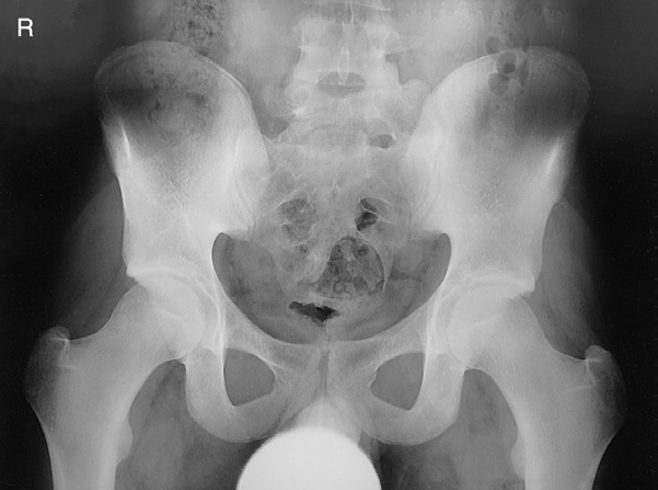 Fig. 7-16 Male pelvis.