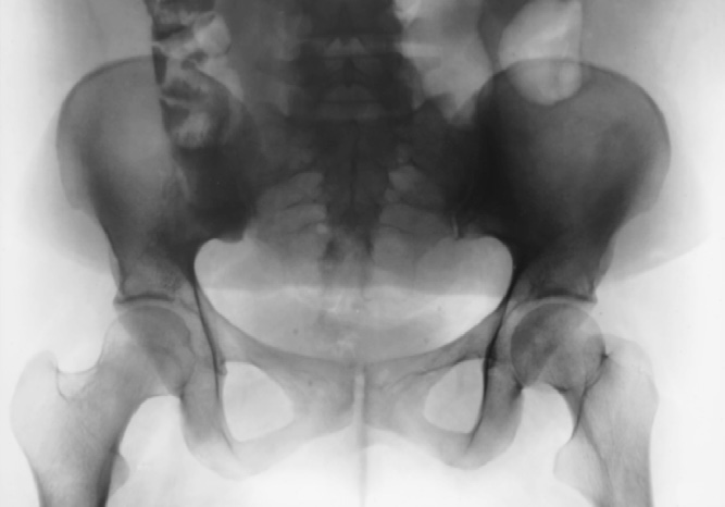 Fig. 7-23 Female pelvis, head (H), and neck (N) locations.