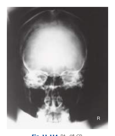 Projection X-Ray